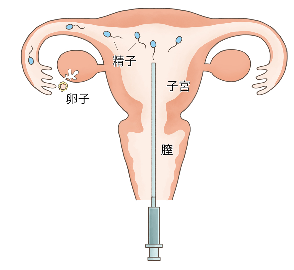 人工 授精 卵胞 の 大き さ