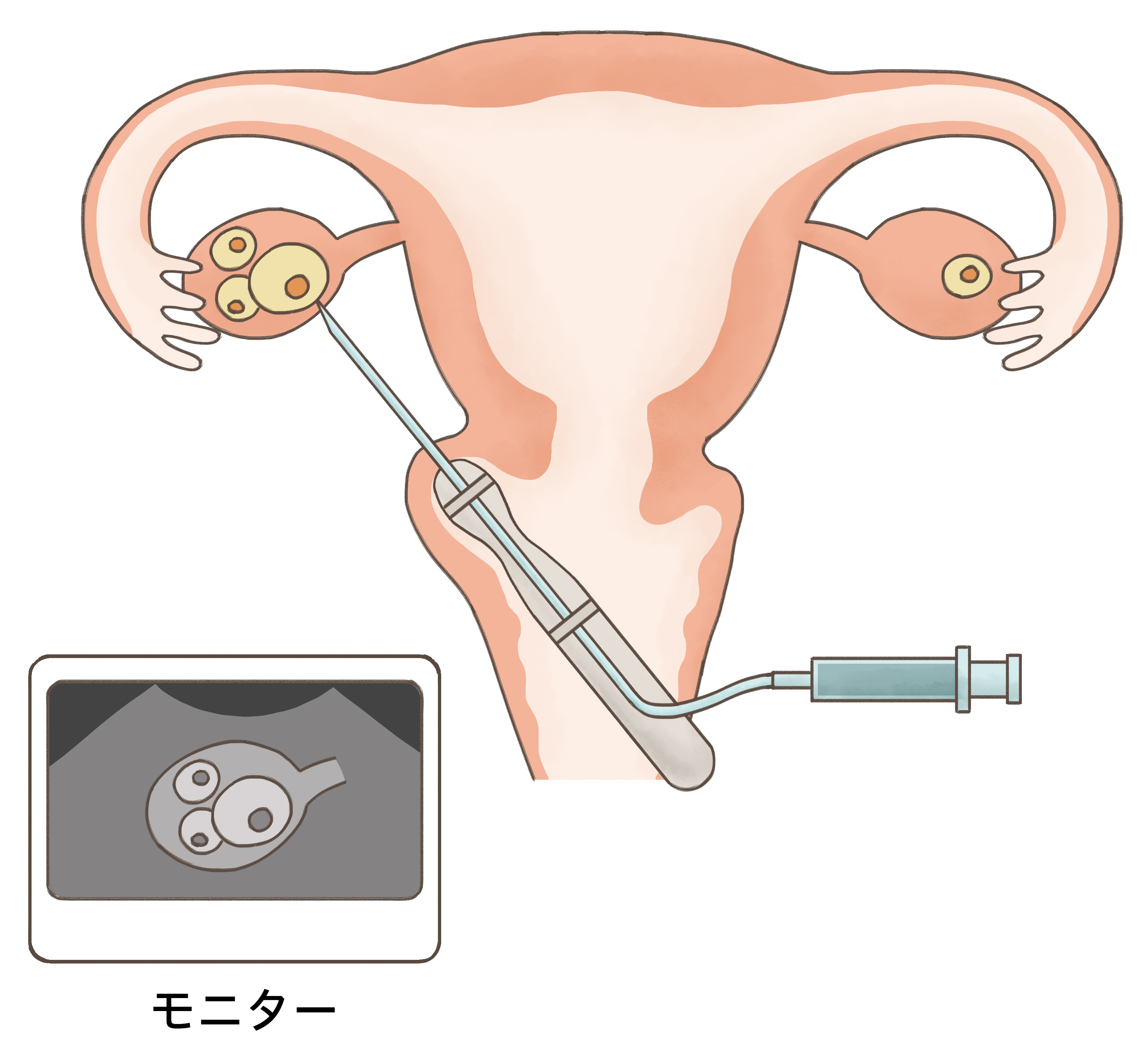 卵子の採り方 精子の採り方 採卵 採精 おち夢クリニック名古屋 不妊治療 体外受精